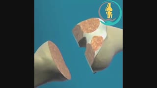 انیمیشن جراحی تعویض مفصل زانو