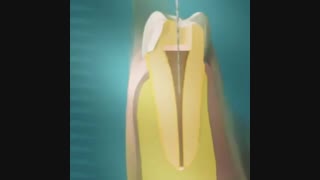 مراحل عصب کشی