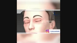بلفاروپلاستی