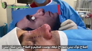 جراحی بینی ترمیمی مشکل با سابقه یکبار جراحی بینی | دکتر باستانی نژاد