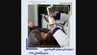 درمان جای جوش های قدیمی با لیزر فرکشنال CO2 ماموپلاستی
