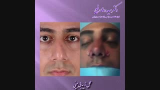 عمل زیبایی بینی مردانه | دکتر سید رضا رفیع | جراح بینی تهران