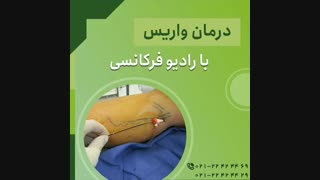 درمان واریس با رادیوفرکانسی