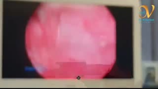 بزرگی خوش خیم پروستات یا bph