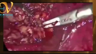 برداشتن تومور غده فوق کلیه ( آدرنال) با لاپاراسکوپی