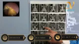 اندوسکوپی سنگ کلیه یا pcnl