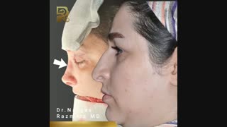 بلافاصله پس از جراحى زیبایى بینی همراه با جراحی پلک