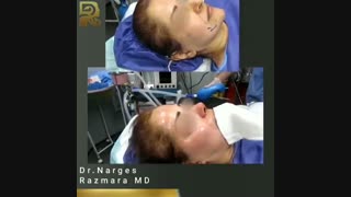 تزریق چربی به صورت و رینوپلاستی