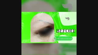 کاشت ابرو مراجعه کننده از اصفهان