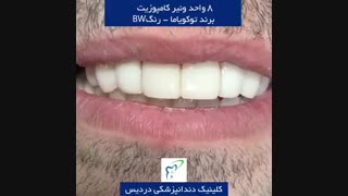 نتیجه کامپوزیت دندان