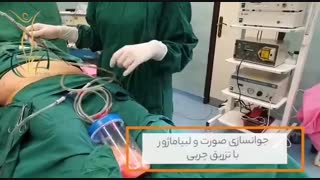 جوانسازی صورت و لبیاماژور با تزریق چربی لیزر مو