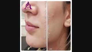 ویدئو واقعی زاویه سازی فک با فیلر