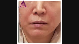 نتیجه بی نظیر هایفوتراپی