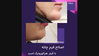 فیلم واقعی اصلاح فرم چانه