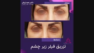 تزریق فیلر زیر چشم
