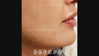 مدلینگ چانه با تزریق فیلر هیالورونیک