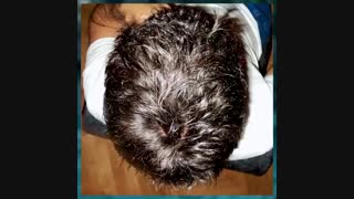 پروتز مو با جنس موی انسان 09198858620