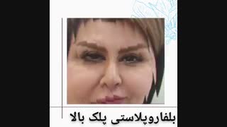 بلفاروپلاستی پلک بالا