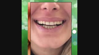 کامپوزیت دندان توسط خانم دکتر شهرزاد احمد