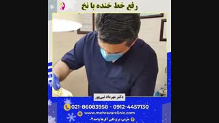 رفع خط خنده با نخ