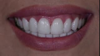 طراحی لبخند با تکنیک دیجیتال و لمینیتهای سرامیکی