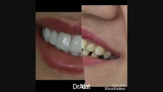 لمینیتهای سرامیکی