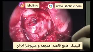 جراحی تومور هیپوفیز بزرگ