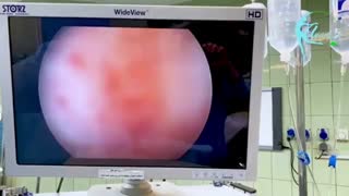 هیستروسکوپی میومکتومی در خانم 38 ساله با خونریزی شدید