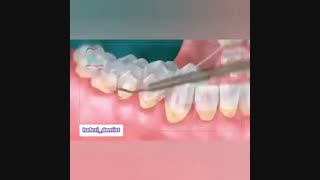 نحوه انجام جرمگیری دندان