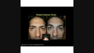 نمونه کارهای جراحی لیفت ابرو | پروفسور کشکولی | فوق تخصص جراحی پلاستیک چشم