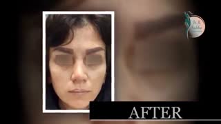 نمونه عمل زیبایی بینی