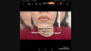 آموزش لیفت با نخ و انجام تخصصی لیفت ابرو لیفت بینی و..