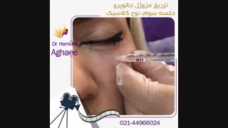 فیلم تزریق مزوژل جالپرو کاشت مو