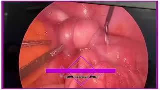 جراحی کیست تخمدان