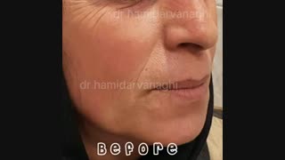 ویدئو واقعی هایفوتراپی و معجزه آن
