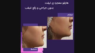 معجزه هایفو بدون نیاز به جراحی