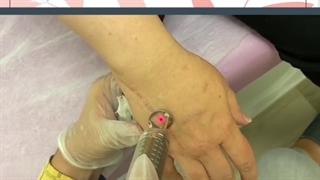 فیلم از بین بردن جای بخیه با لیزر