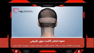 کاشت مو - بررسی مراحل، روش ها و هزینه پیوند مو