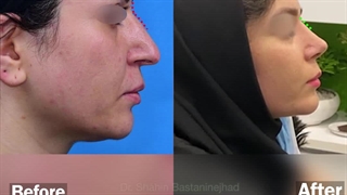 دو ماه بعد از جراحی بینی در بیمار با انحراف و عدم تقارن بینی | دکتر باستانی نژاد