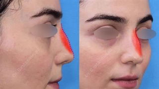سه ماه بعد از جراحی زیبایی بینی در بینی پیچدار با قوز مختصر | دکتر باستانی نژاد