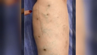 اثرات زالودرمانی در درمان واریس