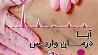 آیا درمان واریس دائمی است؟ پیلینگ شیمیایی