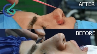 فیلم جراحی بینی استخوانی قوزدار