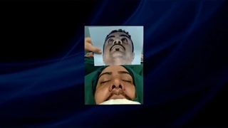 نمونه کار جراحی بینی مردانه طبیعی