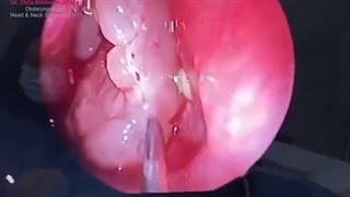 ⏪جراحى تومور بزرگ بینى به روش آندوسکوپى از داخل بینى، بدون برش و بخیه⏩