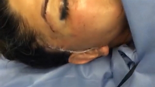 فیلم جراحی لیفت صورت