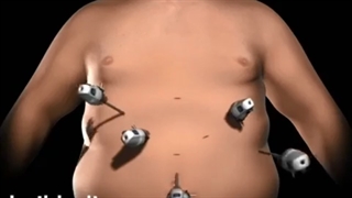 بای پس معده چگونه انجام می شود؟