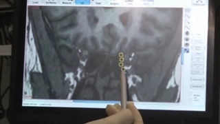 فیلم واقعی جراحی شکستگی قاعده جمجمه در دو نقطه