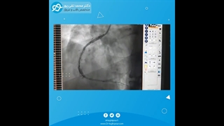 آنژیوپلاستی عروق قلبی