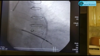 استنت گذاری در قلب